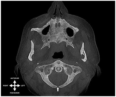 Anatomical variations of the atlas arches: prevalence assessment, systematic review and proposition for an updated classification system